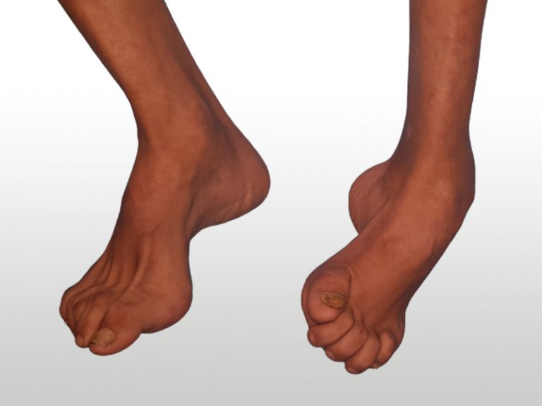 Foot deformities