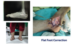Flat Feet Treatment