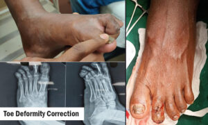 Toe deformity correction