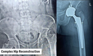 Hip Reconstruction