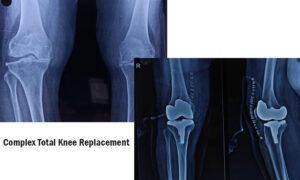 Complex total knee replacement