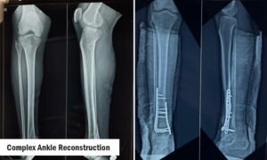 Complex Ankle Reconstruction