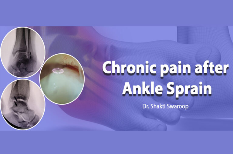 Chronic pain after ankle Sprain Dr. Shakti Swaroop