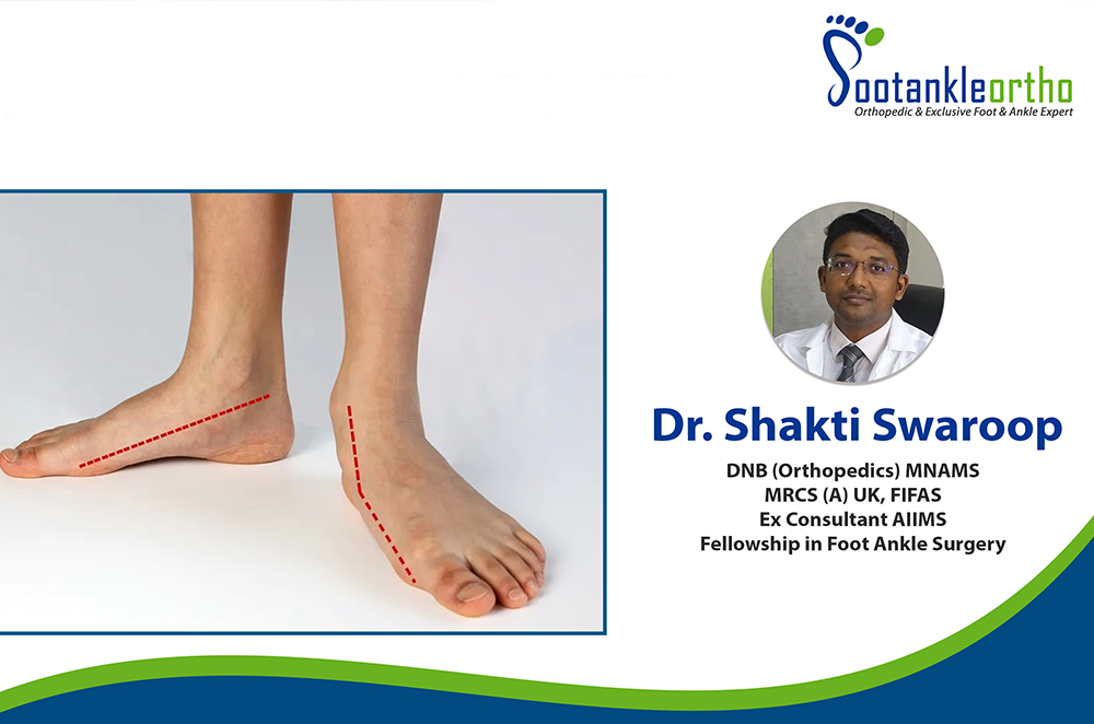 Flat Feet- Types, Causes & Treatment