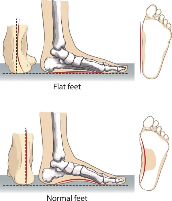 flat feet 02