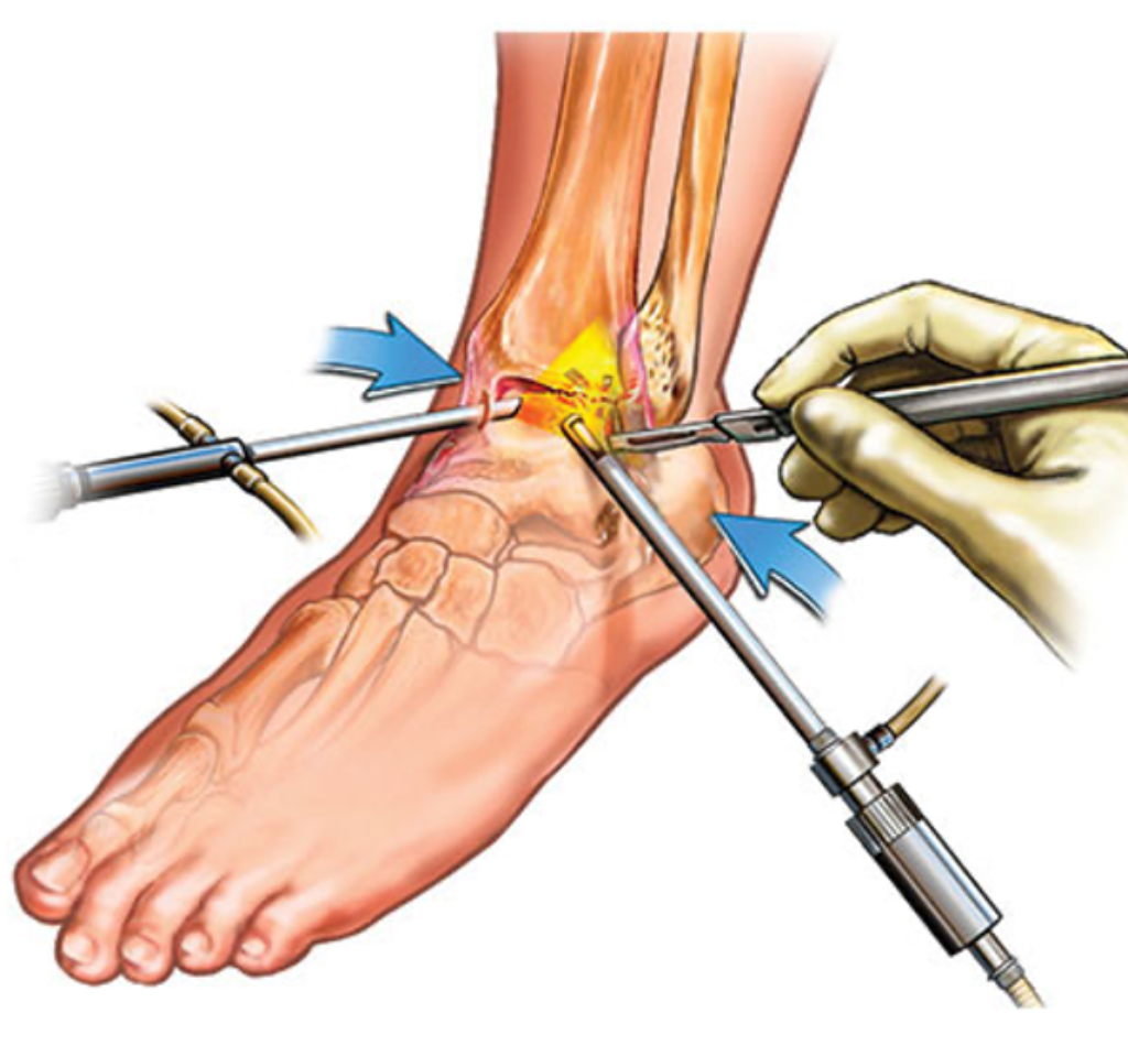 ankle ligament repair