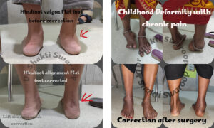 Foot Deformities Correction