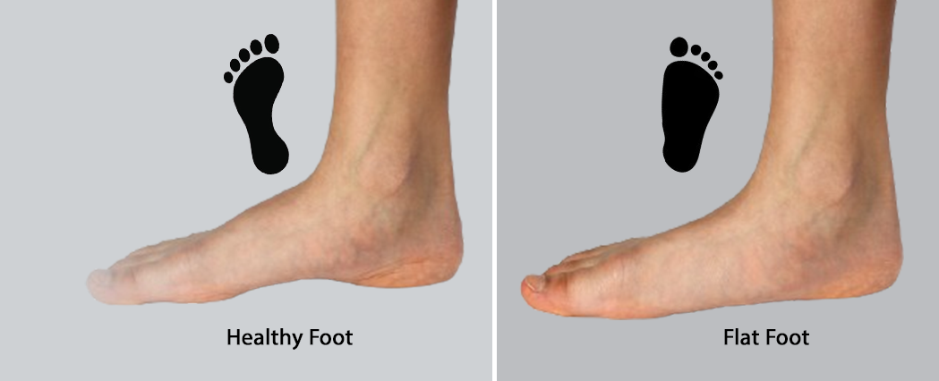 Flat Foot