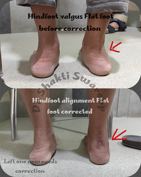 Flat-Foot Treatment