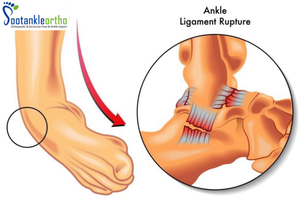 Ankle Ligament Injuries