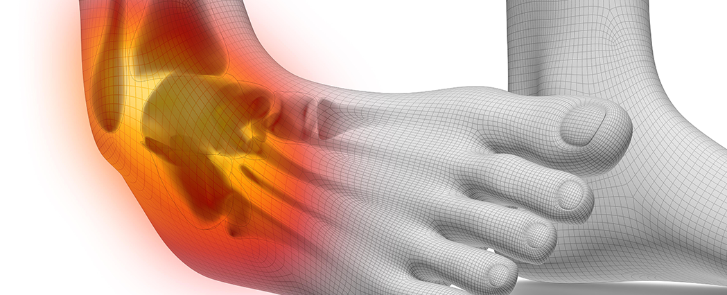 Ankle-Sprain Ankle-Sprain