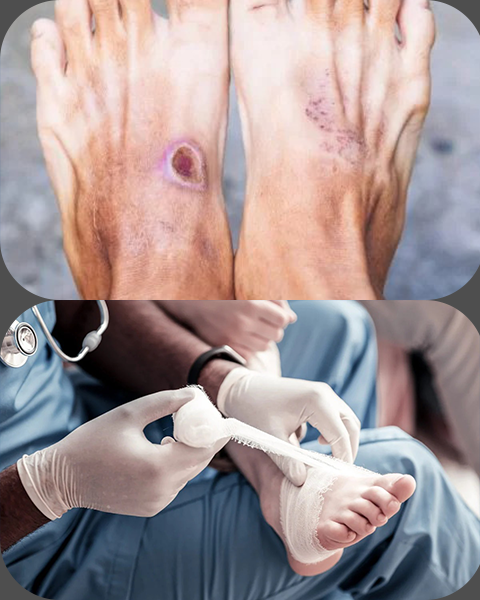 Diabetic Foot 1 Diabetic-Foot-Treatment