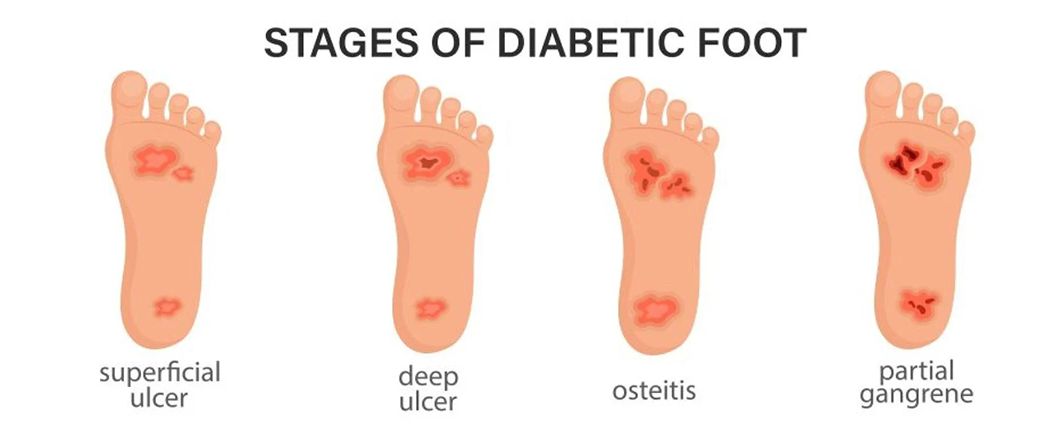 Diabetic foot stages Diabetic Foot Stages