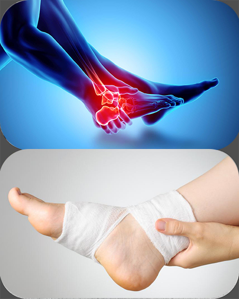 Ankle Sprain 1 ankle-sprain-recovery