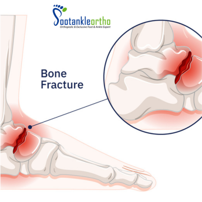Foot Fracture : Causes, Symptoms & Expert Treatment by Dr. Shakti Swaroop at Footankleortho.com 2 foot bone fracture
