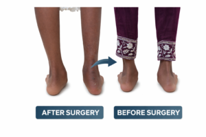 Flat foot correction