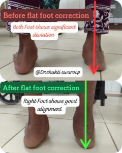 Flat foot correction