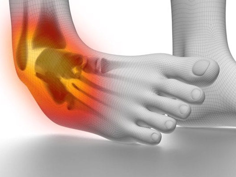 Ankle ligament injuries