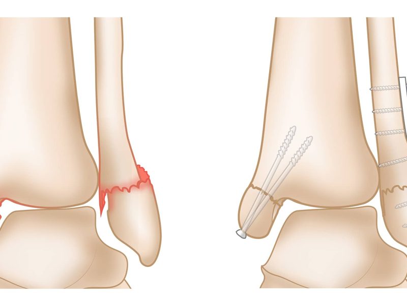 Complex ankle fractures
