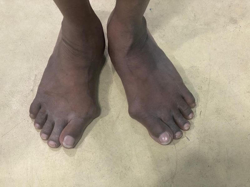 Flat foot & foot Deformities