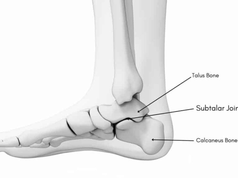 Subtalar Arthritis