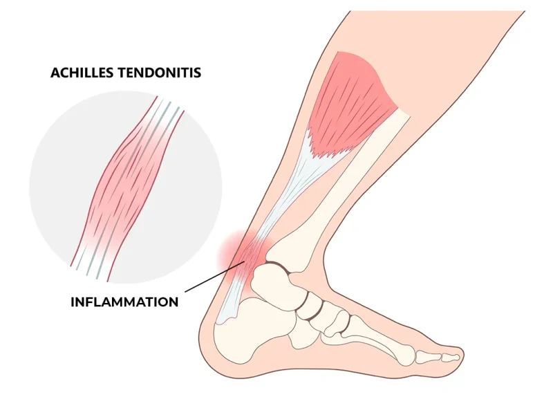 Tendon Achilles Problems